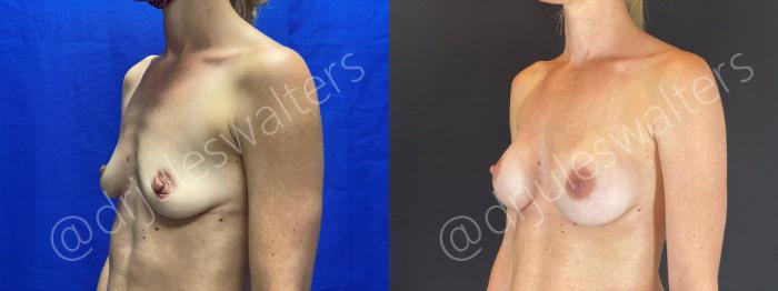 Before & After Breast Augmentation Case 68 View #2 View in Metairie and New Orleans, LA