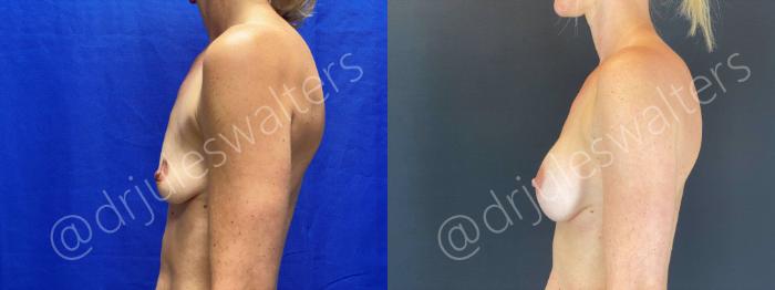 Before & After Breast Augmentation Case 68 View #3 View in Metairie and New Orleans, LA