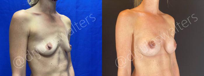 Before & After Breast Augmentation Case 68 View #4 View in Metairie and New Orleans, LA