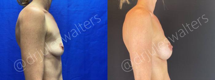 Before & After Breast Augmentation Case 68 View #5 View in Metairie and New Orleans, LA