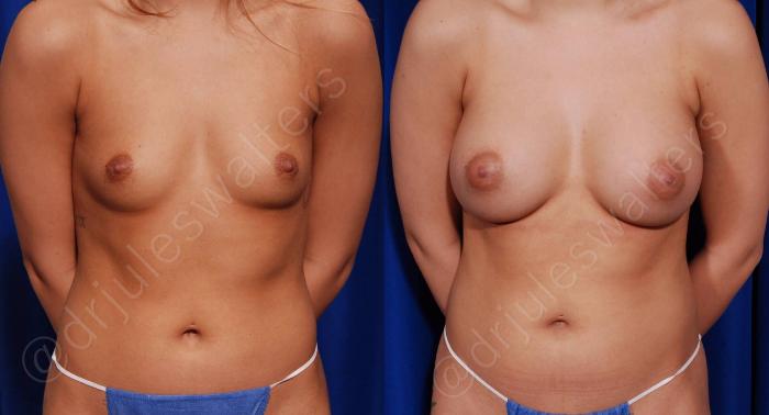 Before & After Breast Augmentation Case 69 View #1 View in Metairie and New Orleans, LA