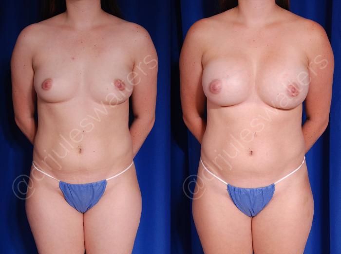 Before & After Breast Augmentation Case 71 View #1 View in Metairie and New Orleans, LA