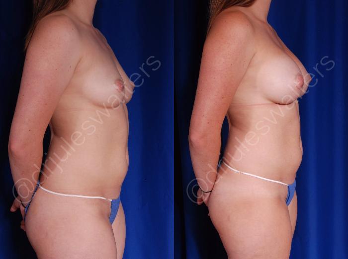 Before & After Breast Augmentation Case 71 View #2 View in Metairie and New Orleans, LA