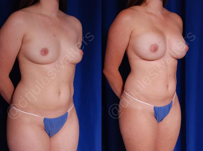 Before & After Breast Augmentation Case 71 View #4 View in Metairie and New Orleans, LA
