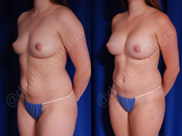 Before & After Breast Augmentation Case 71 View #5 View in Metairie and New Orleans, LA