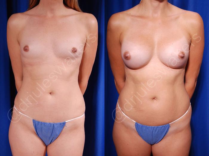 Before & After Breast Augmentation Case 72 View #1 View in Metairie and New Orleans, LA