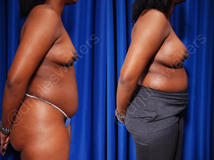 Before & After Breast Augmentation Case 74 View #2 View in Metairie and New Orleans, LA