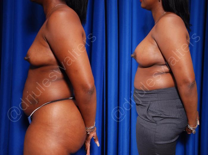 Before & After Breast Augmentation Case 74 View #3 View in Metairie and New Orleans, LA