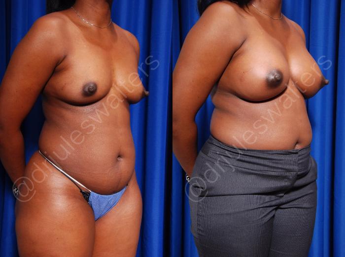 Before & After Breast Augmentation Case 74 View #4 View in Metairie and New Orleans, LA