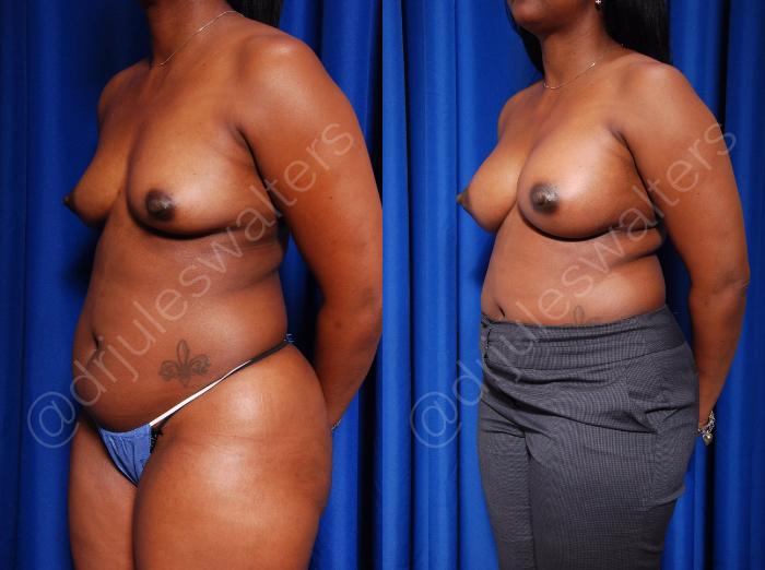 Before & After Breast Augmentation Case 74 View #5 View in Metairie and New Orleans, LA