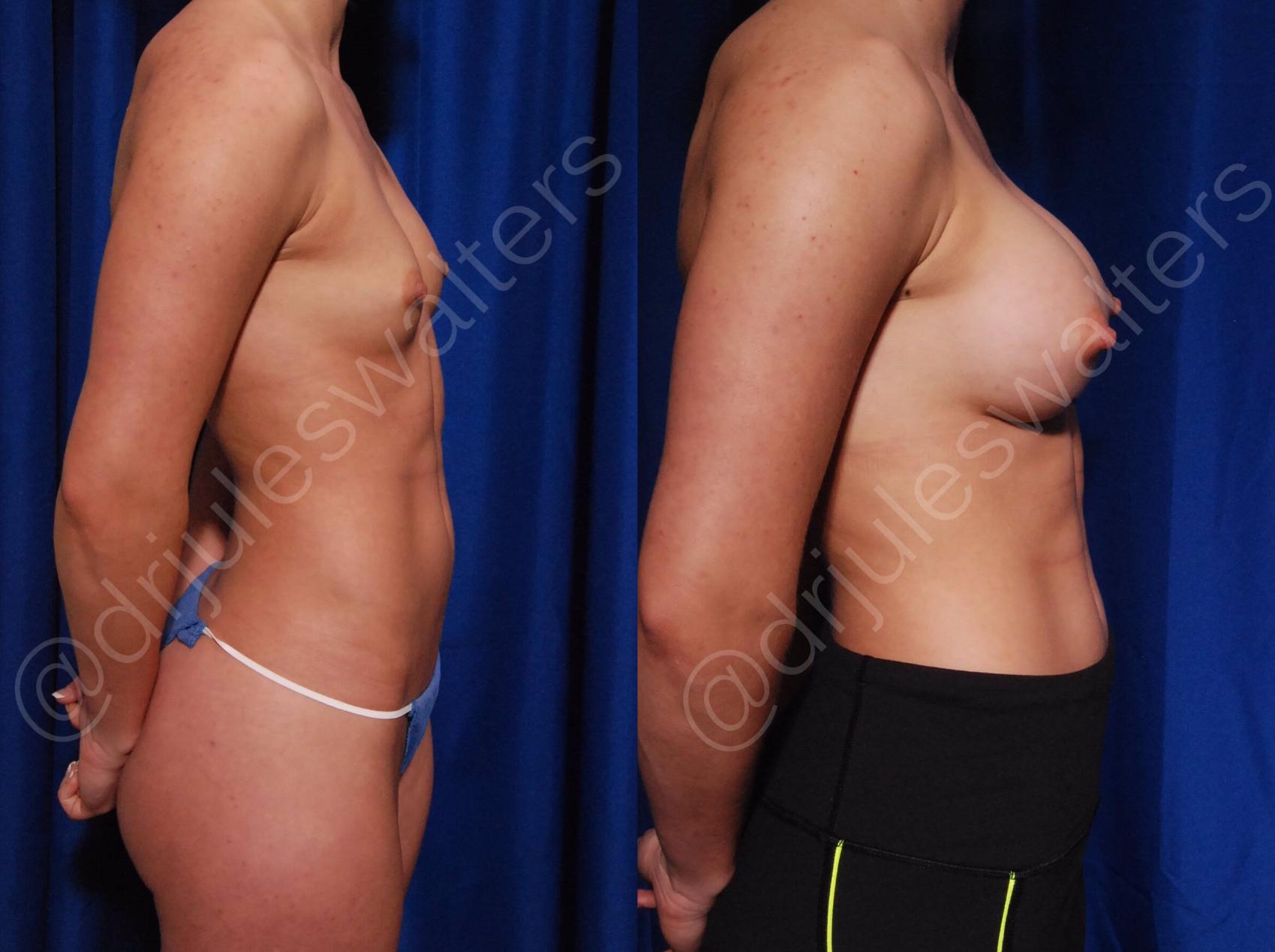 Before & After Breast Augmentation Case 75 View #2 View in Metairie, New Orleans, Covington, LA