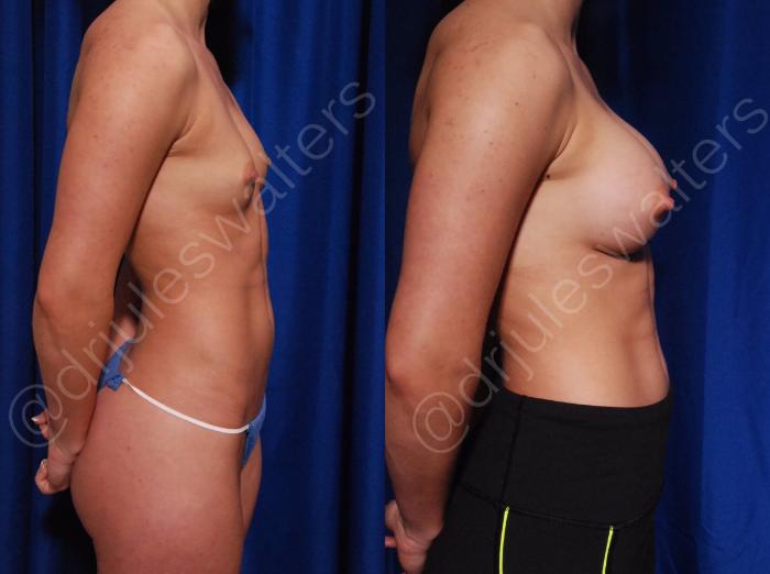 Before & After Breast Augmentation Case 75 View #2 View in Metairie and New Orleans, LA