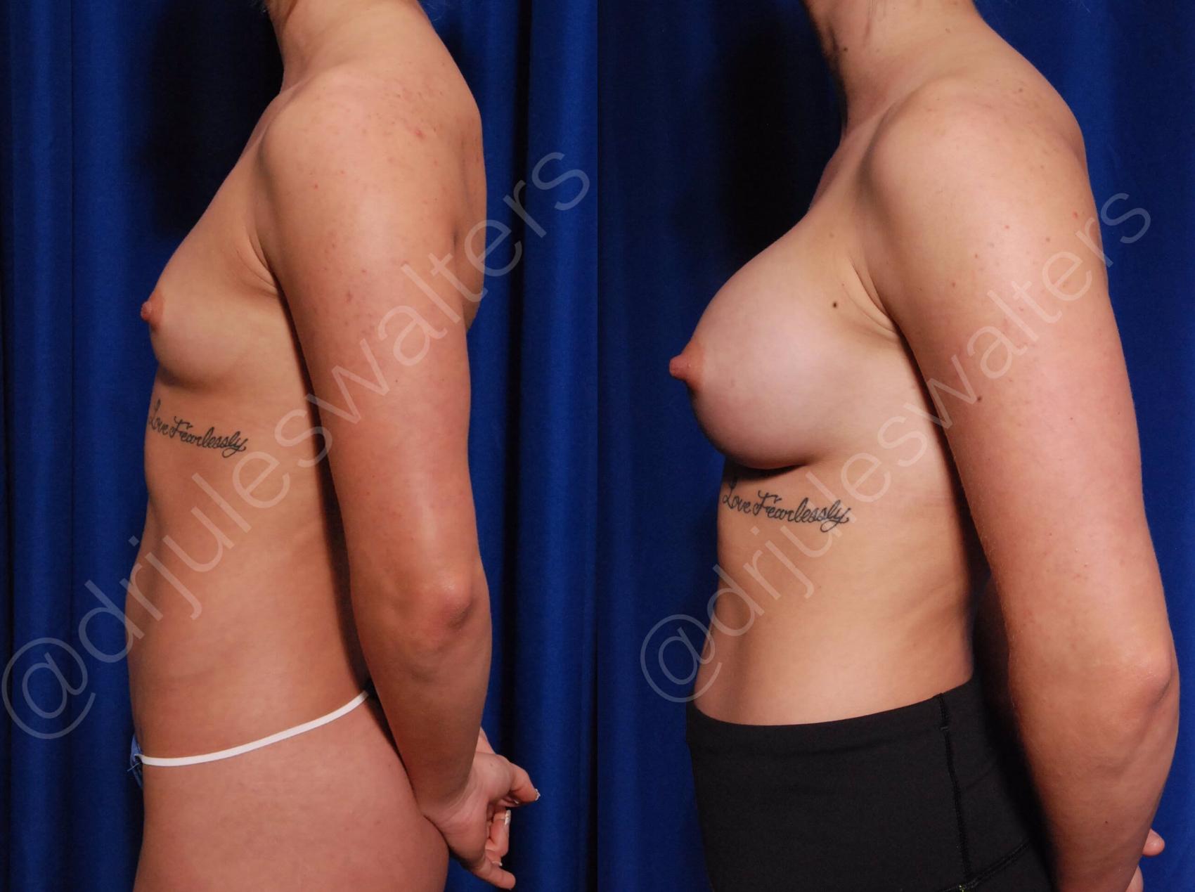 Before & After Breast Augmentation Case 75 View #3 View in Metairie, New Orleans, Covington, LA