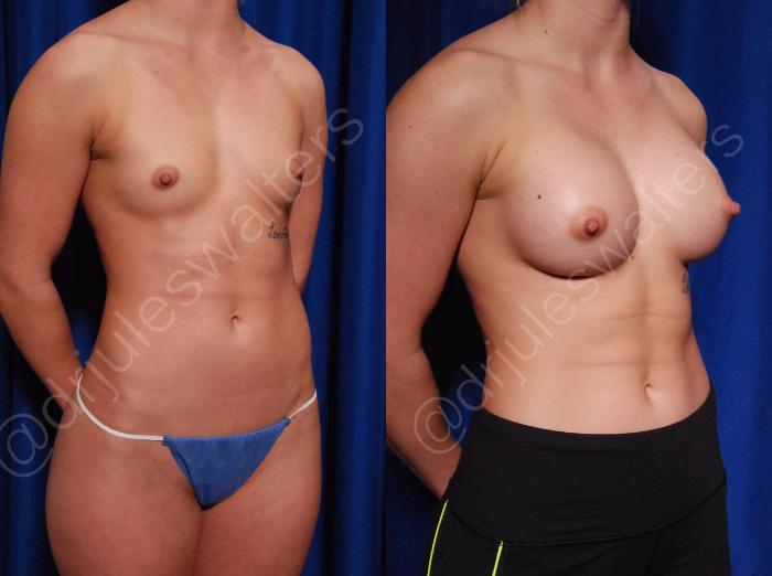 Before & After Breast Augmentation Case 75 View #4 View in Metairie and New Orleans, LA