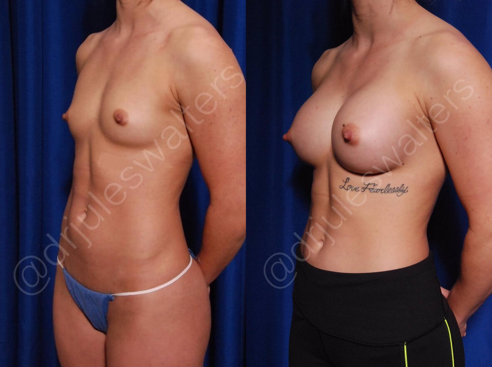 Before & After Breast Augmentation Case 75 View #5 View in Metairie, New Orleans, Covington, LA