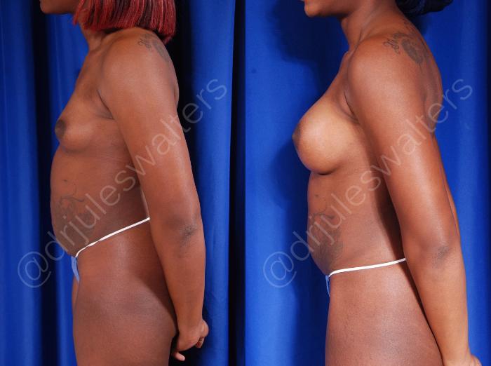 Before & After Breast Augmentation Case 76 View #5 View in Metairie and New Orleans, LA