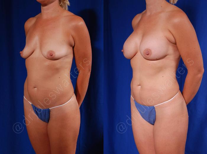 Before & After Breast Augmentation Case 78 View #2 View in Metairie and New Orleans, LA