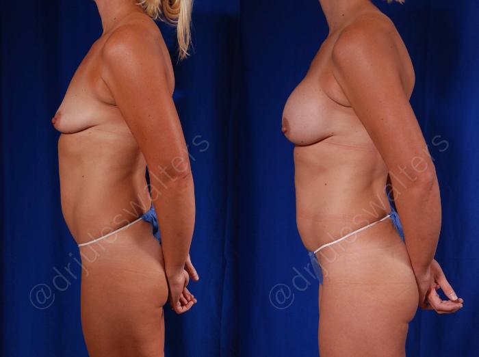 Before & After Breast Augmentation Case 78 View #3 View in Metairie and New Orleans, LA