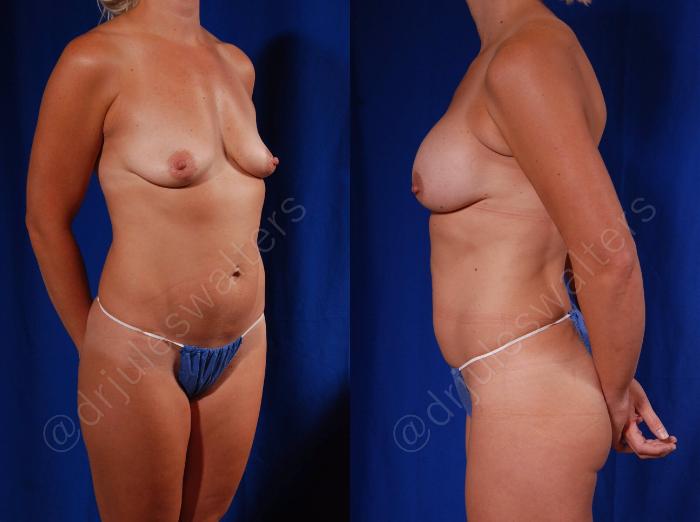 Before & After Breast Augmentation Case 78 View #4 View in Metairie and New Orleans, LA