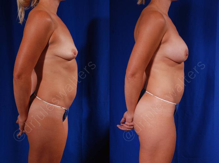 Before & After Breast Augmentation Case 78 View #5 View in Metairie and New Orleans, LA