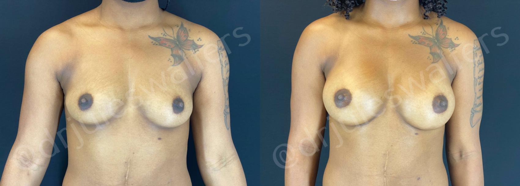Before & After Breast Augmentation Case 79 View #1 View in Metairie, New Orleans, Covington, LA