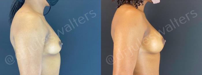 Before & After Breast Augmentation Case 79 View #2 View in Metairie and New Orleans, LA
