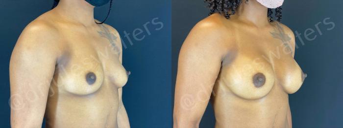 Before & After Breast Augmentation Case 79 View #3 View in Metairie and New Orleans, LA