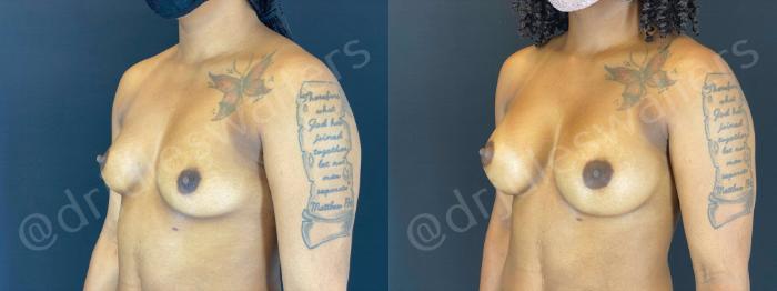 Before & After Breast Augmentation Case 79 View #5 View in Metairie and New Orleans, LA