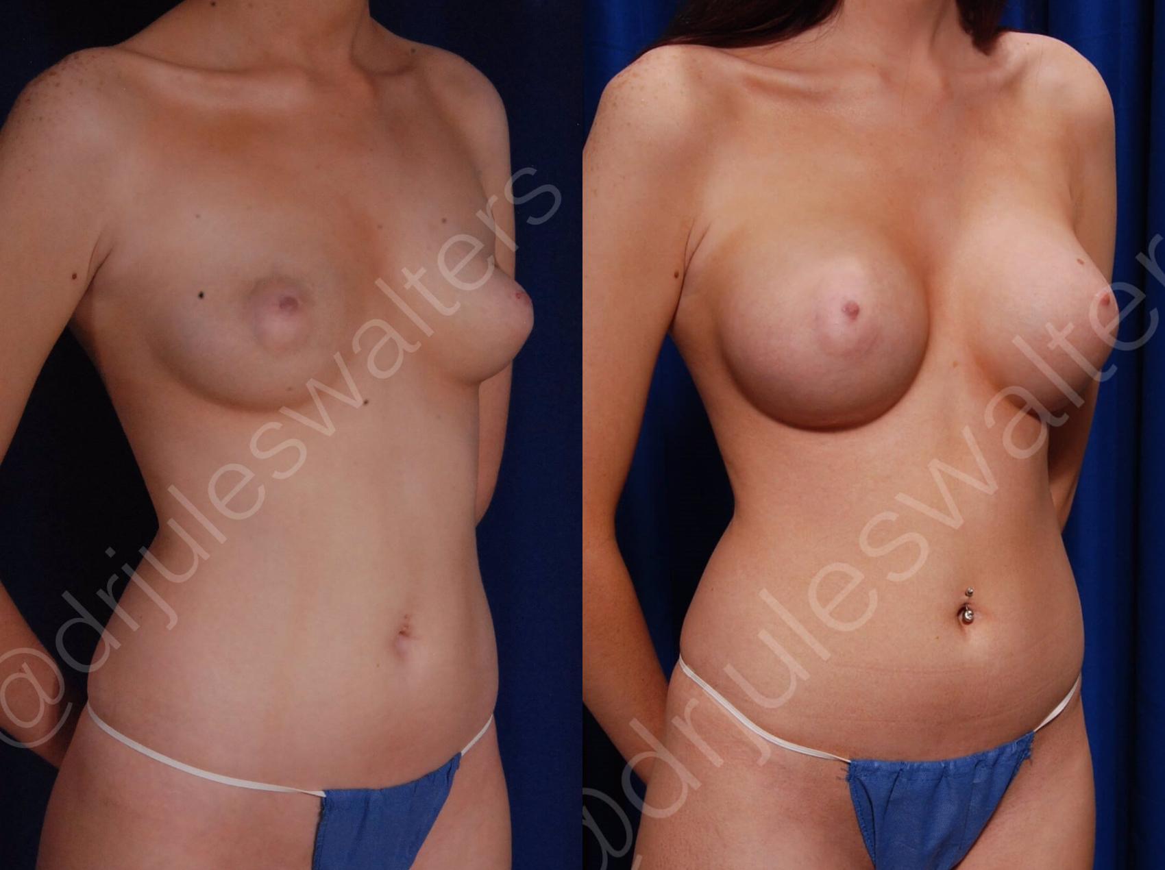 Before & After Breast Augmentation Case 80 View #2 View in Metairie, New Orleans, Covington, LA
