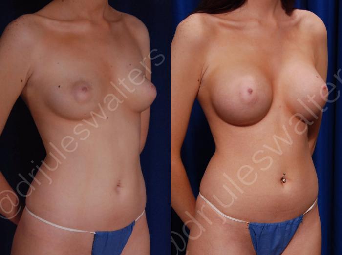 Before & After Breast Augmentation Case 80 View #2 View in Metairie and New Orleans, LA