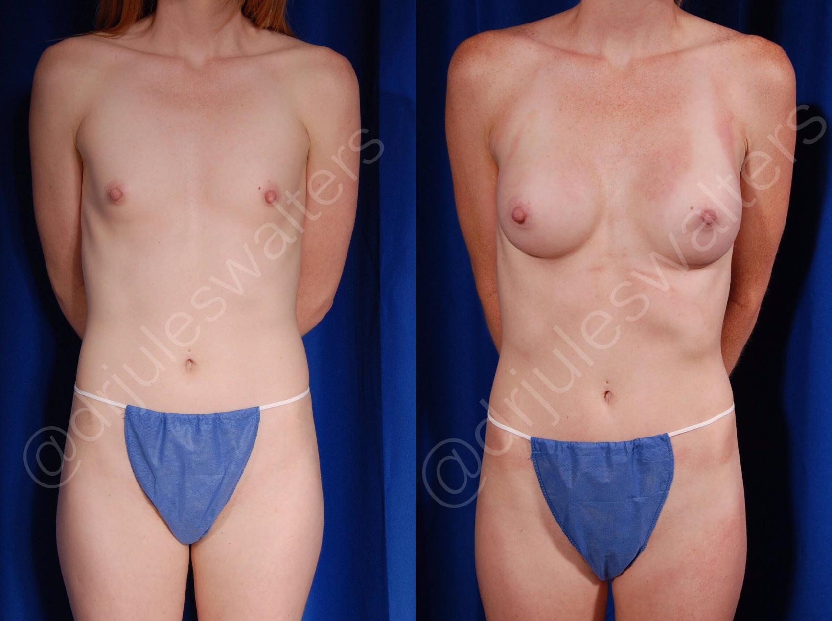 Before & After Breast Augmentation Case 81 View #1 View in Metairie and New Orleans, LA