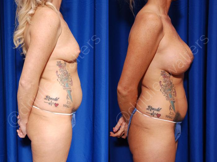 Before & After Breast Augmentation Case 82 View #2 View in Metairie and New Orleans, LA