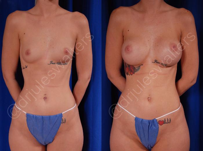 Before & After Breast Augmentation Case 83 View #1 View in Metairie and New Orleans, LA