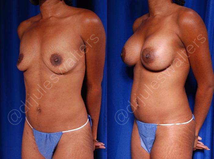 Before & After Breast Augmentation Case 85 View #3 View in Metairie and New Orleans, LA