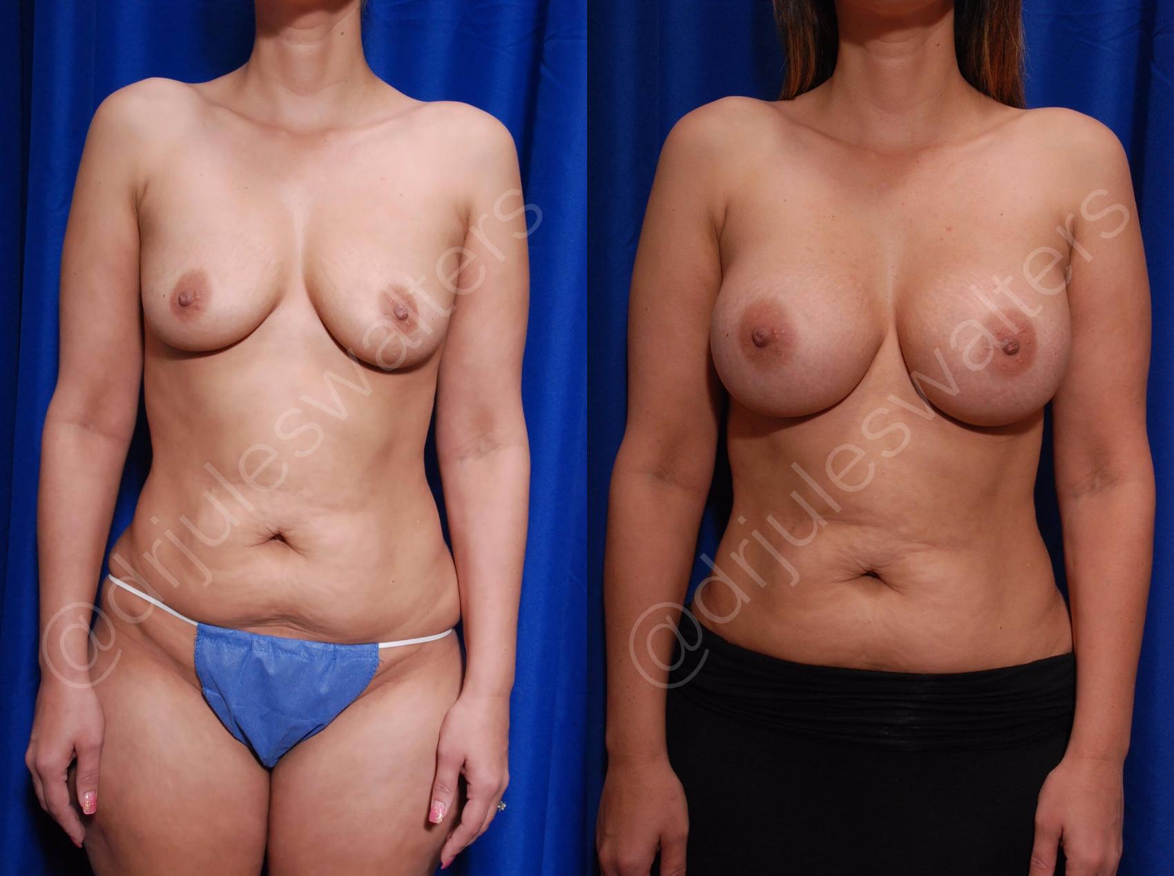 Before & After Breast Augmentation Case 87 View #1 View in Metairie, New Orleans, Covington, LA
