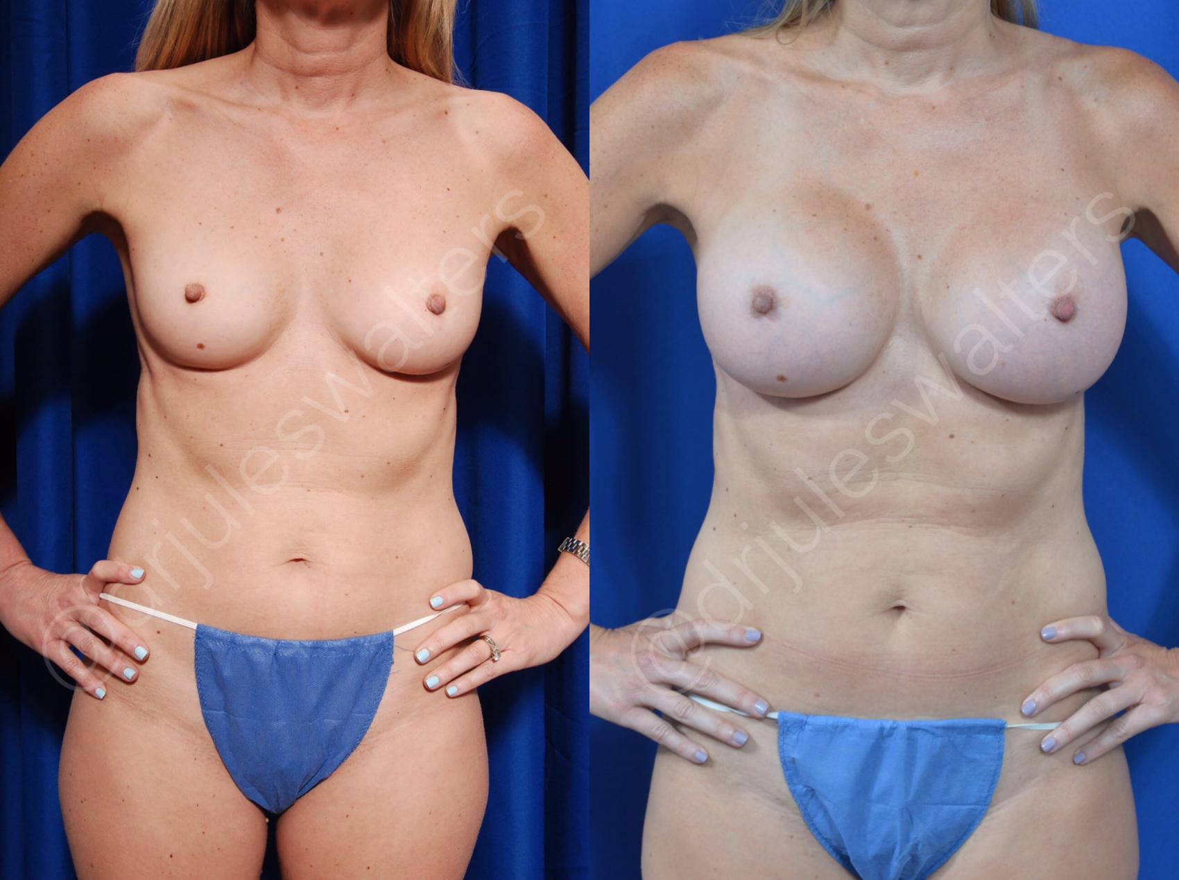 Before & After Breast Augmentation Case 88 View #1 View in Metairie and New Orleans, LA