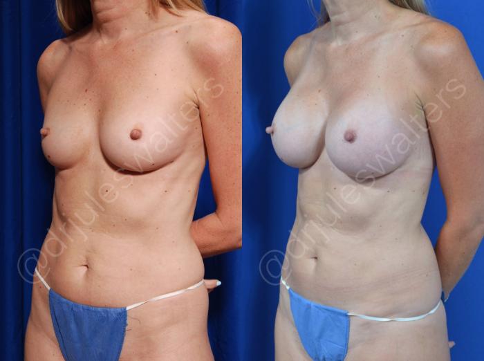 Before & After Breast Augmentation Case 88 View #5 View in Metairie and New Orleans, LA
