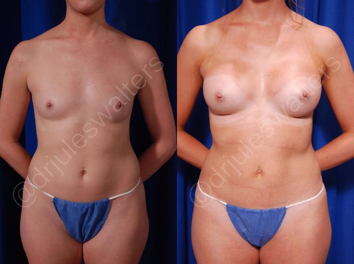 Before & After Breast Augmentation Case 89 View #1 View in Metairie and New Orleans, LA