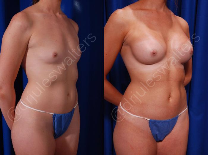 Before & After Breast Augmentation Case 89 View #2 View in Metairie and New Orleans, LA