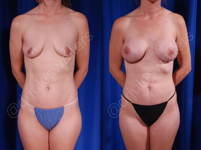 Before & After Breast Augmentation Case 91 View #1 View in Metairie and New Orleans, LA