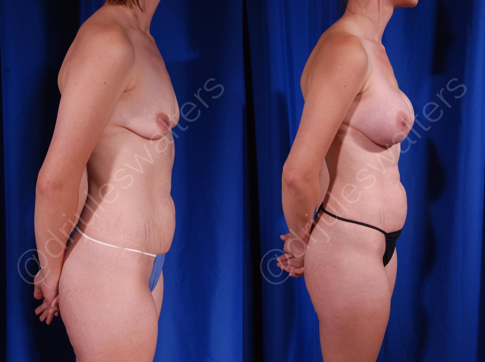 Before & After Breast Augmentation Case 91 View #2 View in Metairie, New Orleans, Covington, LA