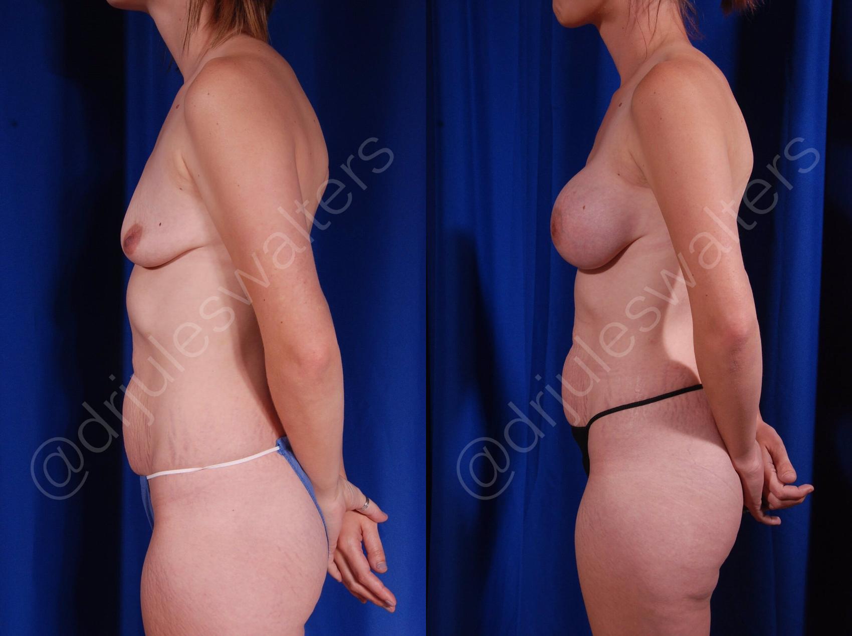 Before & After Breast Augmentation Case 91 View #3 View in Metairie, New Orleans, Covington, LA