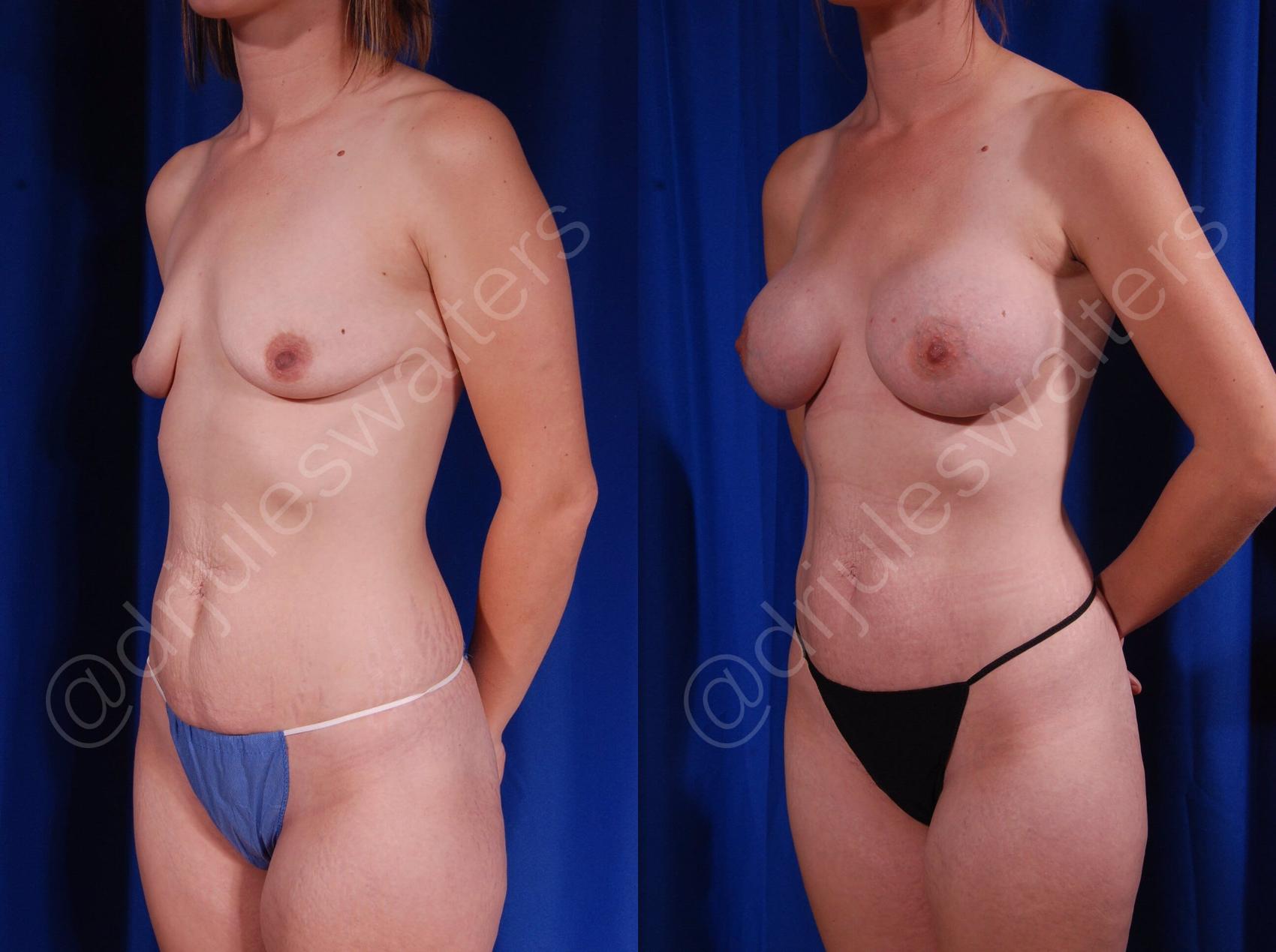 Before & After Breast Augmentation Case 91 View #5 View in Metairie, New Orleans, Covington, LA
