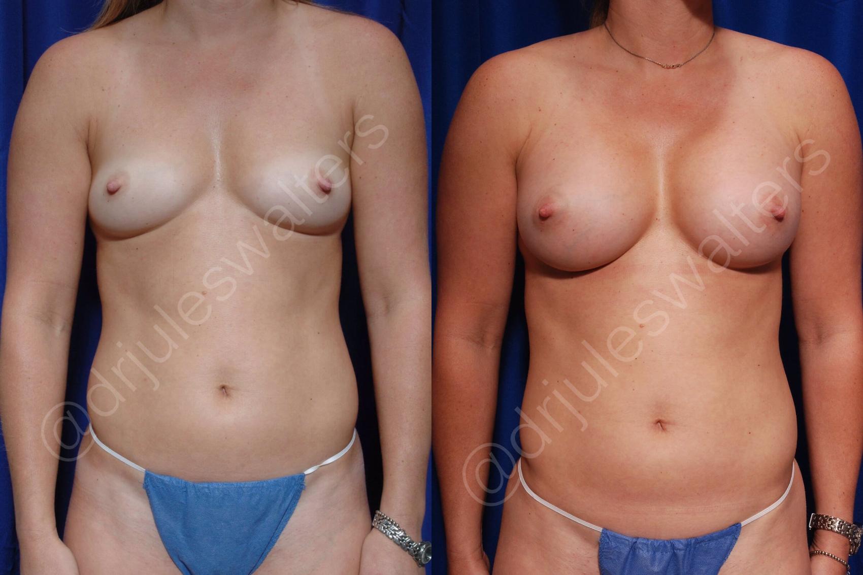 Before & After Breast Augmentation Case 93 View #1 View in Metairie and New Orleans, LA