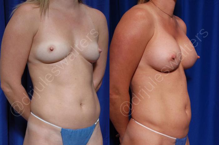 Before & After Breast Augmentation Case 93 View #2 View in Metairie and New Orleans, LA