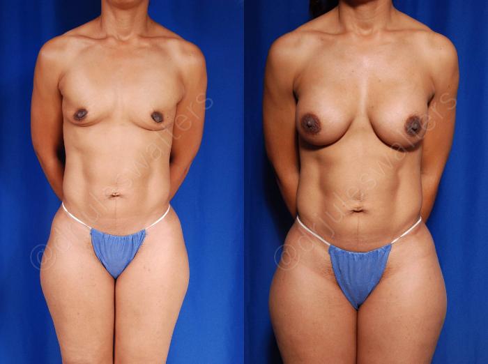 Before & After Breast Augmentation Case 96 View #1 View in Metairie and New Orleans, LA