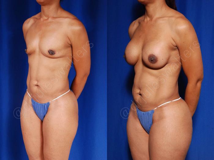 Before & After Breast Augmentation Case 96 View #2 View in Metairie and New Orleans, LA