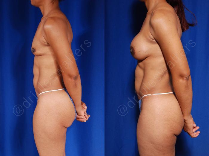 Before & After Liposuction Case 96 View #3 View in Metairie and New Orleans, LA