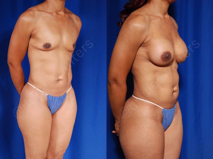 Before & After Breast Augmentation Case 96 View #4 View in Metairie and New Orleans, LA