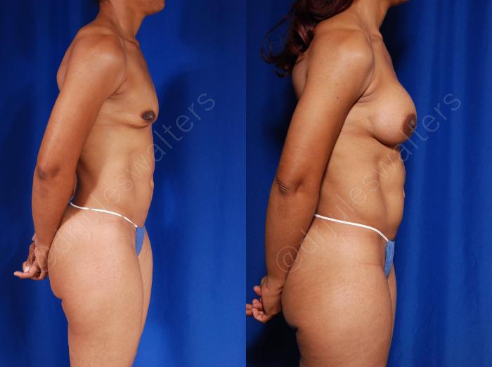 Before & After Breast Augmentation Case 96 View #5 View in Metairie and New Orleans, LA